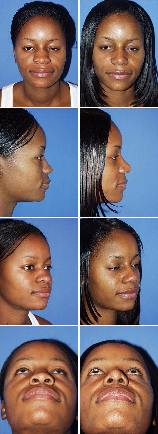 Before and After Image: Rhinoplasty - other