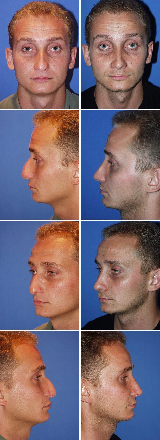 Before and After Image: Rhinoplasty - other