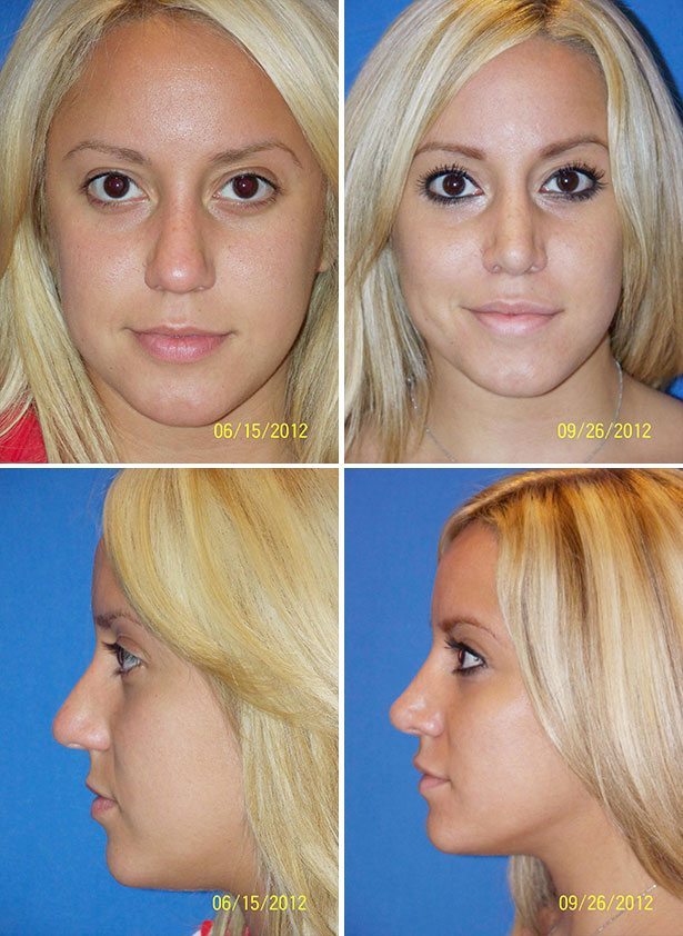 Before and After Image: Rhinoplasty - other