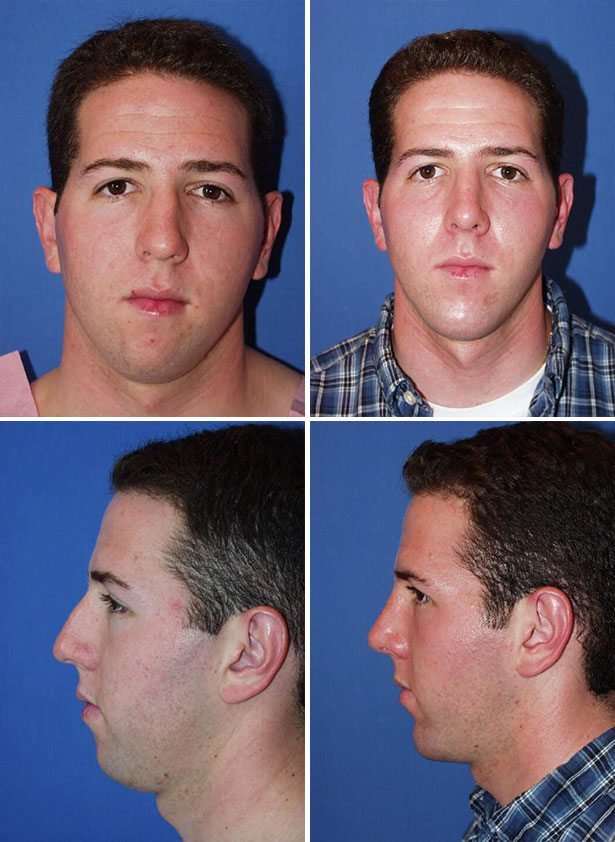 Before and After Image: Chin Augmentation Surgery - other