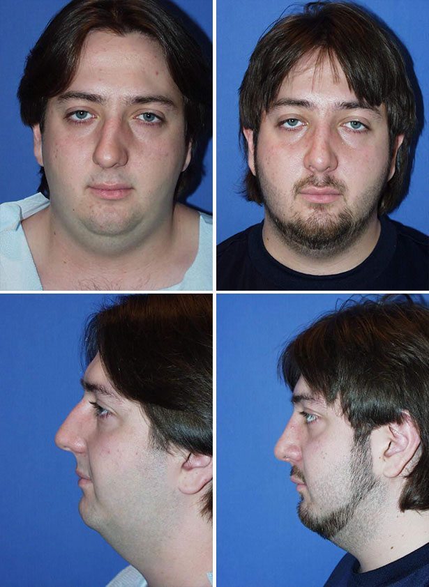Before and After Image: Rhinoplasty - other