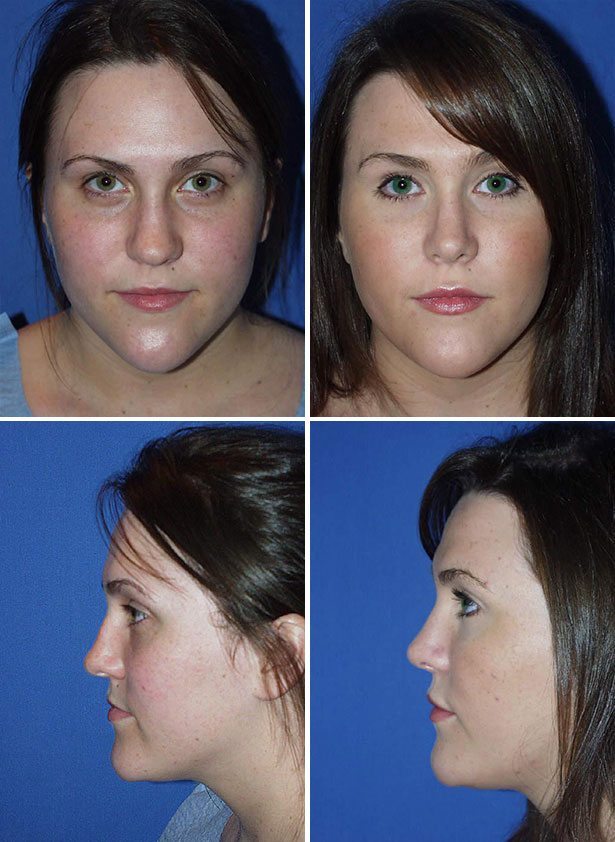Before and After Image: Rhinoplasty - other