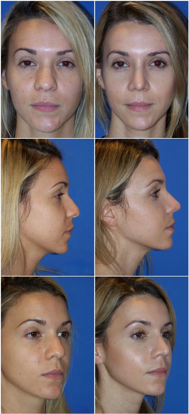 Before and After Image: Rhinoplasty - other