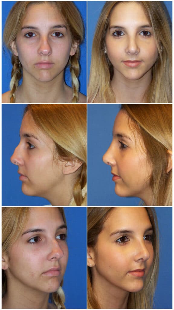Before and After Image: Rhinoplasty - other
