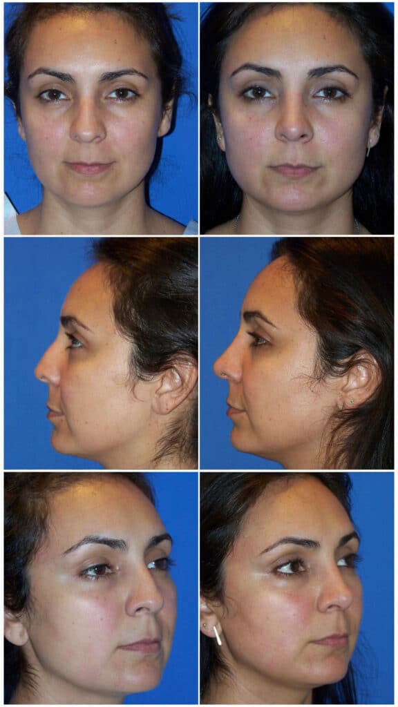 Before and After Image: Rhinoplasty - other