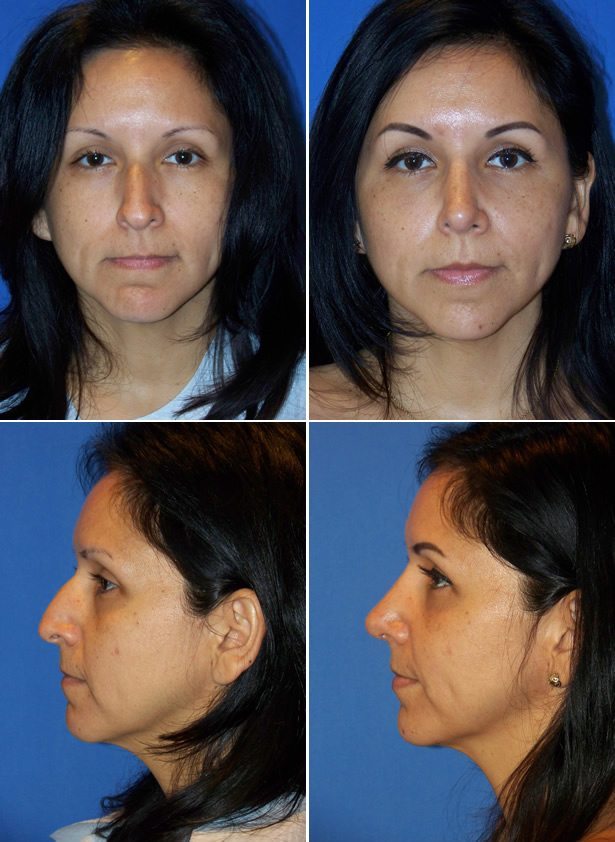 Before and After Image: Rhinoplasty - other