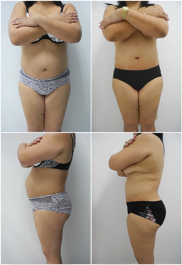 Before and After Image: Tummy Tuck (Abdominoplasty) - other