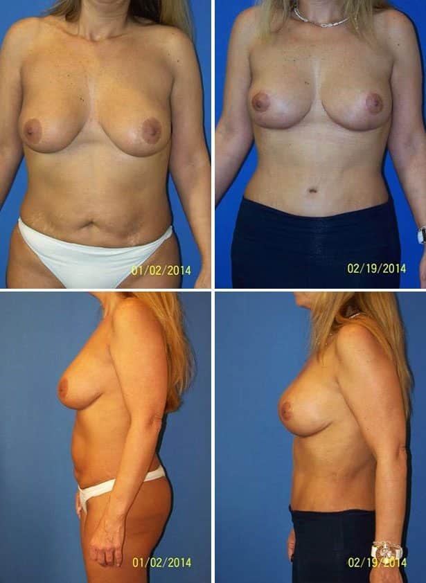 Before and After Image: Tummy Tuck (Abdominoplasty) - other