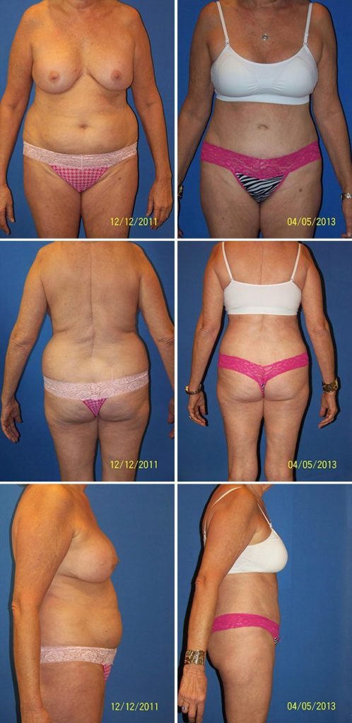 Before and After Image: Tummy Tuck (Abdominoplasty) - other