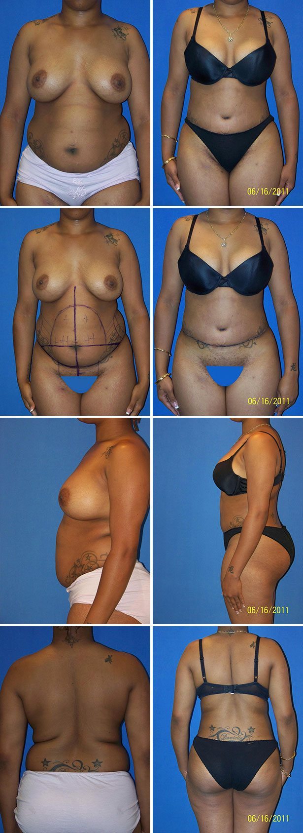 Before and After Image: Tummy Tuck (Abdominoplasty) - other