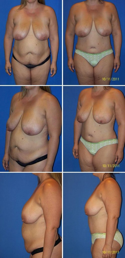 Before and After Image: Tummy Tuck (Abdominoplasty) - other