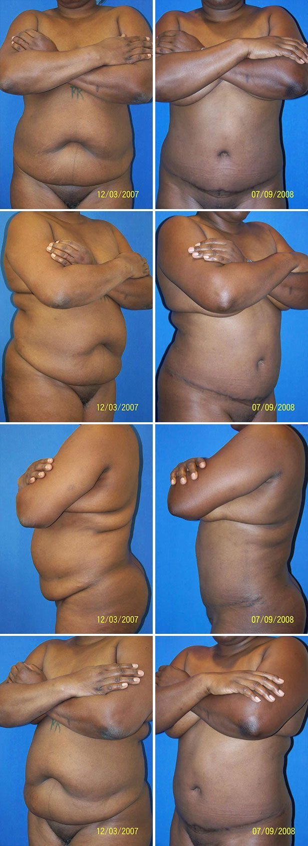Before and After Image: Tummy Tuck (Abdominoplasty) - other