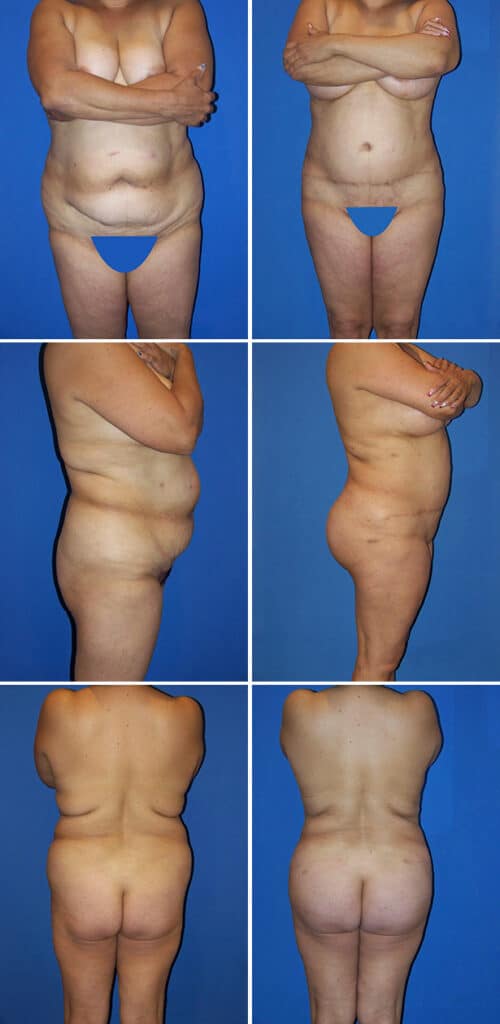 Before and After Image: Tummy Tuck (Abdominoplasty) - other