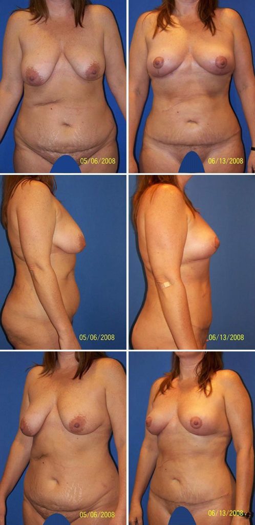 Before and After Image: Tummy Tuck (Abdominoplasty) - other