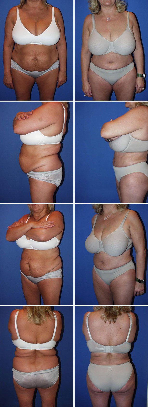 Before and After Image: Tummy Tuck (Abdominoplasty) - other