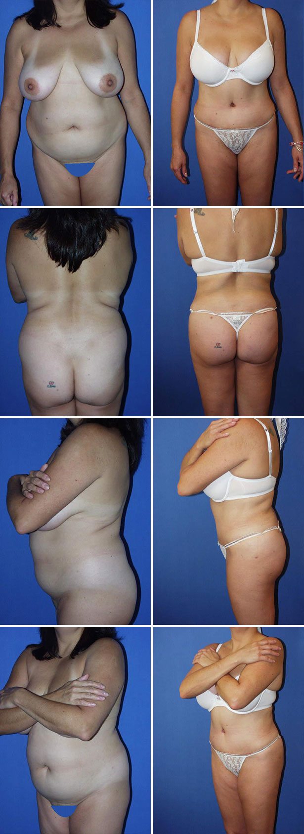 Before and After Image: Tummy Tuck (Abdominoplasty) - other