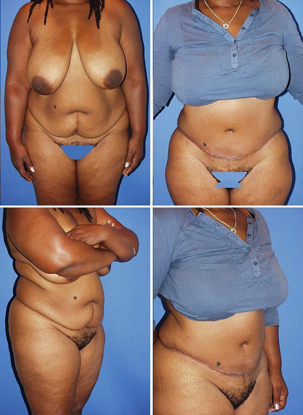Before and After Image: Tummy Tuck (Abdominoplasty) - other