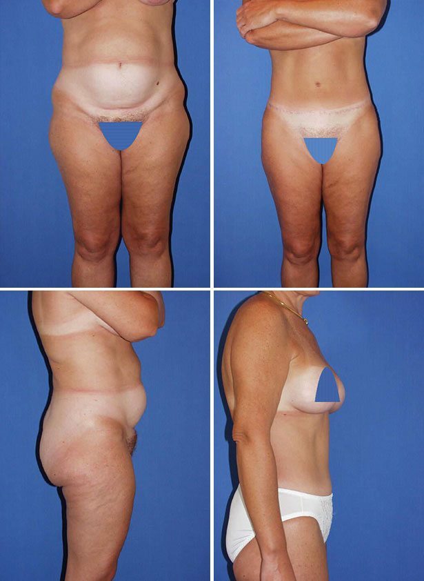 Before and After Image: Tummy Tuck (Abdominoplasty) - other