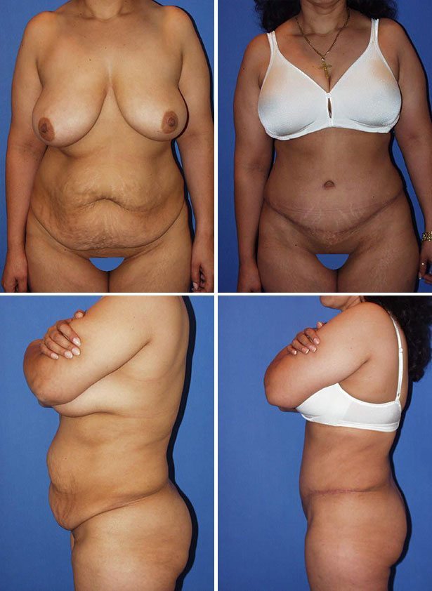 Before and After Image: Tummy Tuck (Abdominoplasty) - other