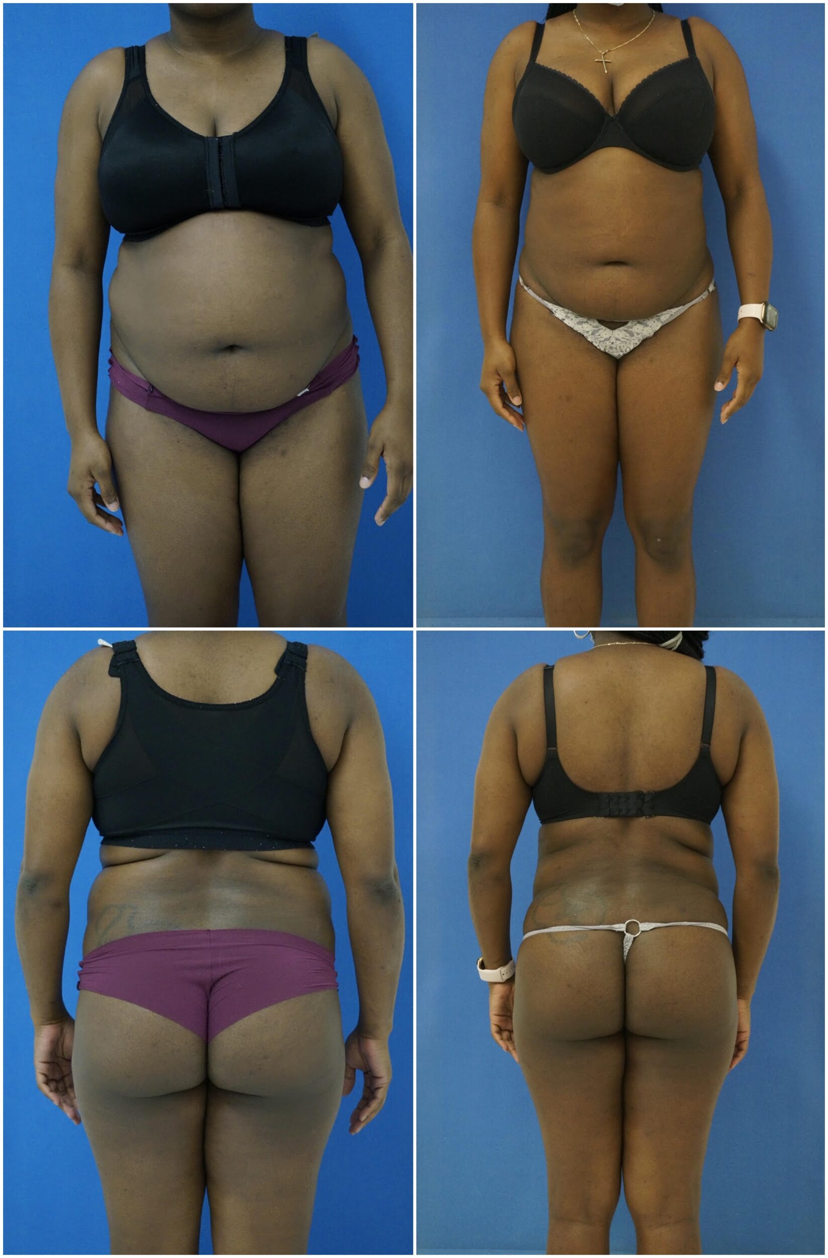 Before and After Image: Liposuction / Liposculpture Surgery - other