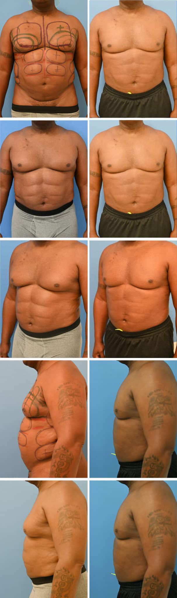 Before and After Image: Male Pectoral Implant - other