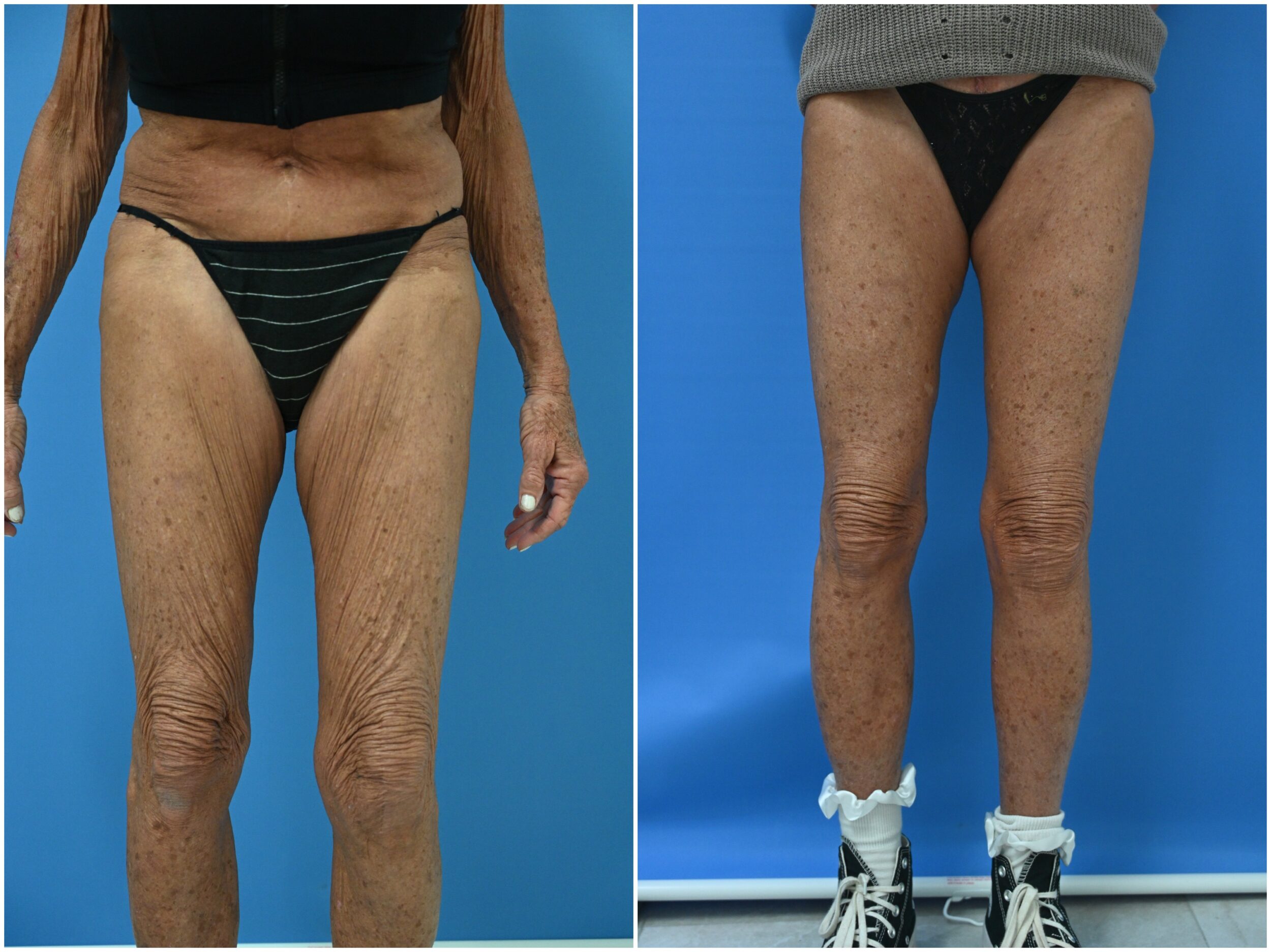 Before and After Image: Thigh Lift - other