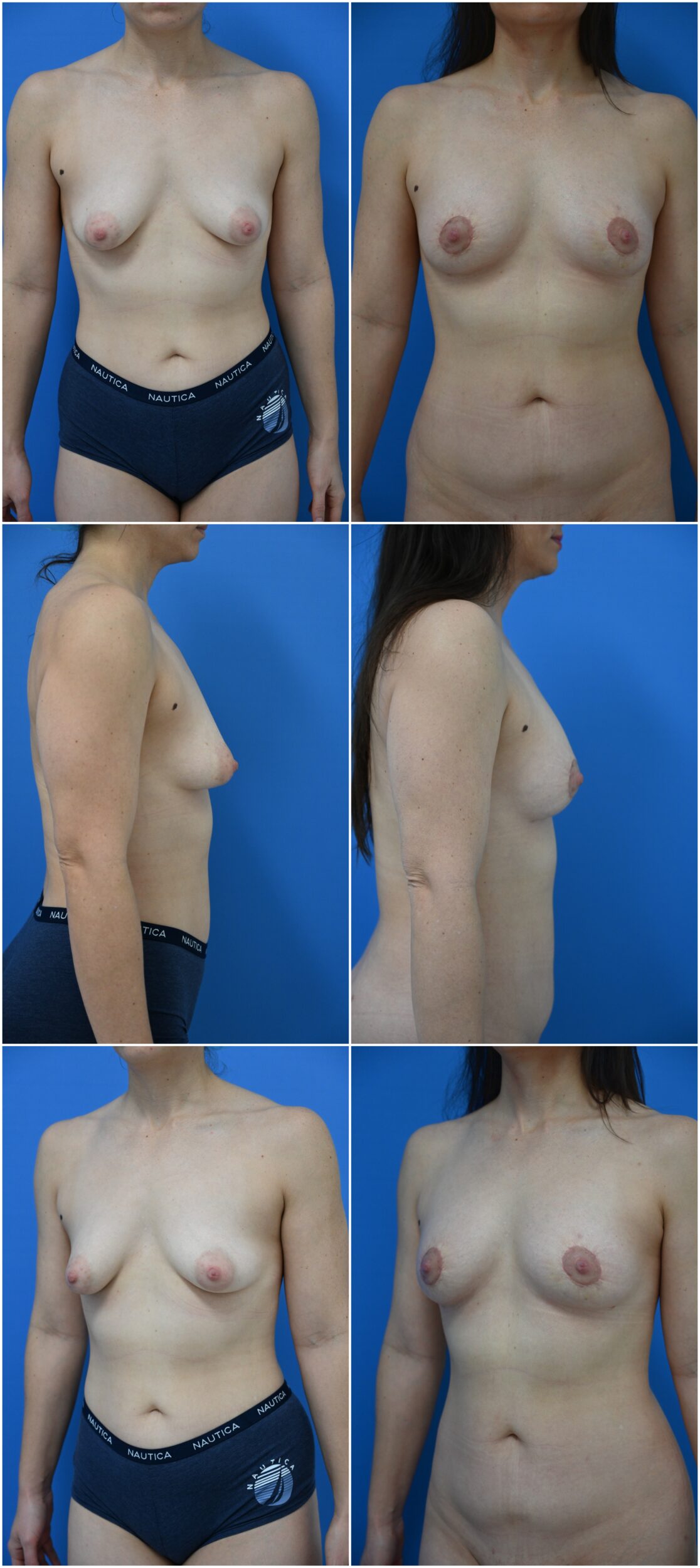 Before and After Image: Breast Lift - other