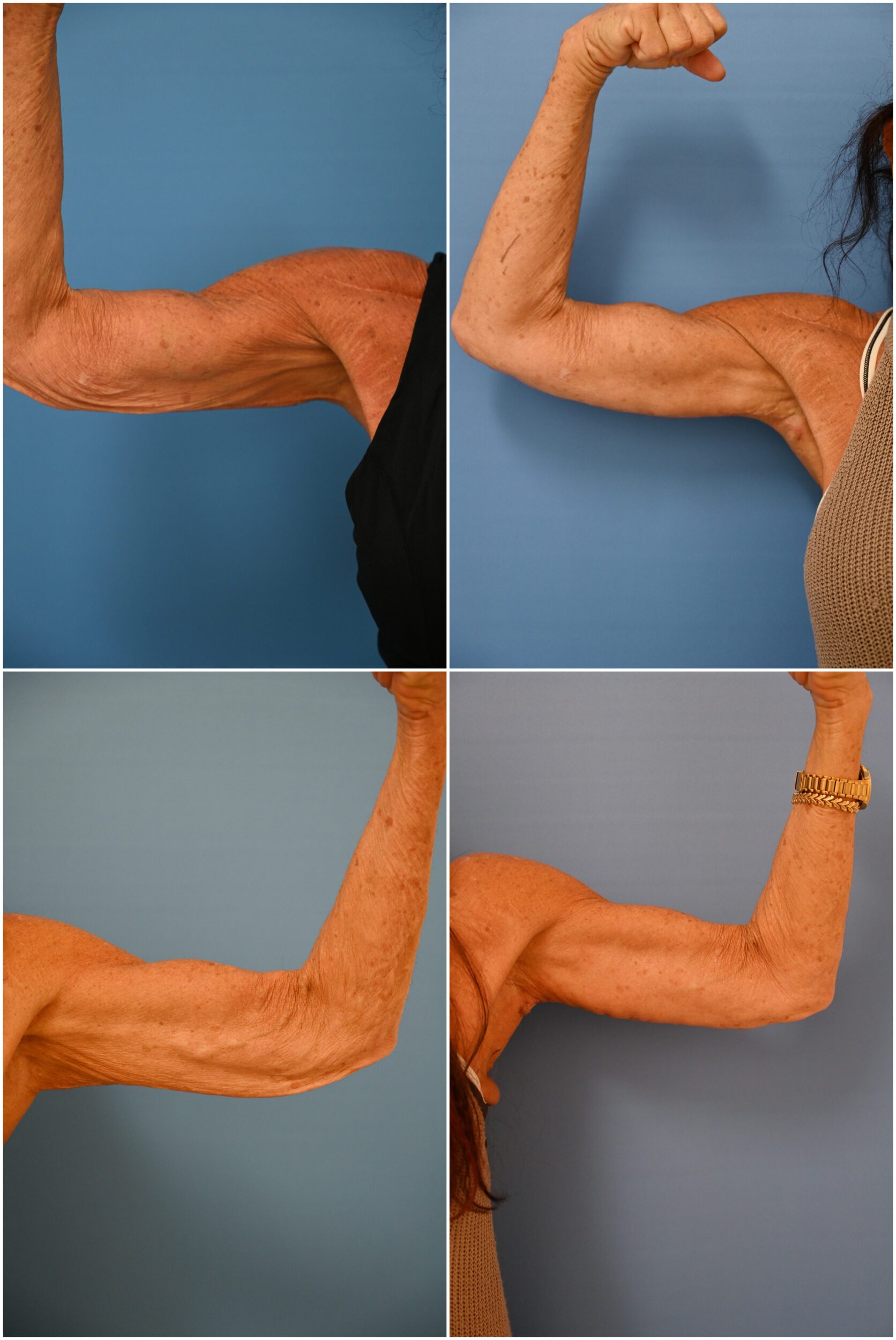 Before and After Image: Brachioplasty - other