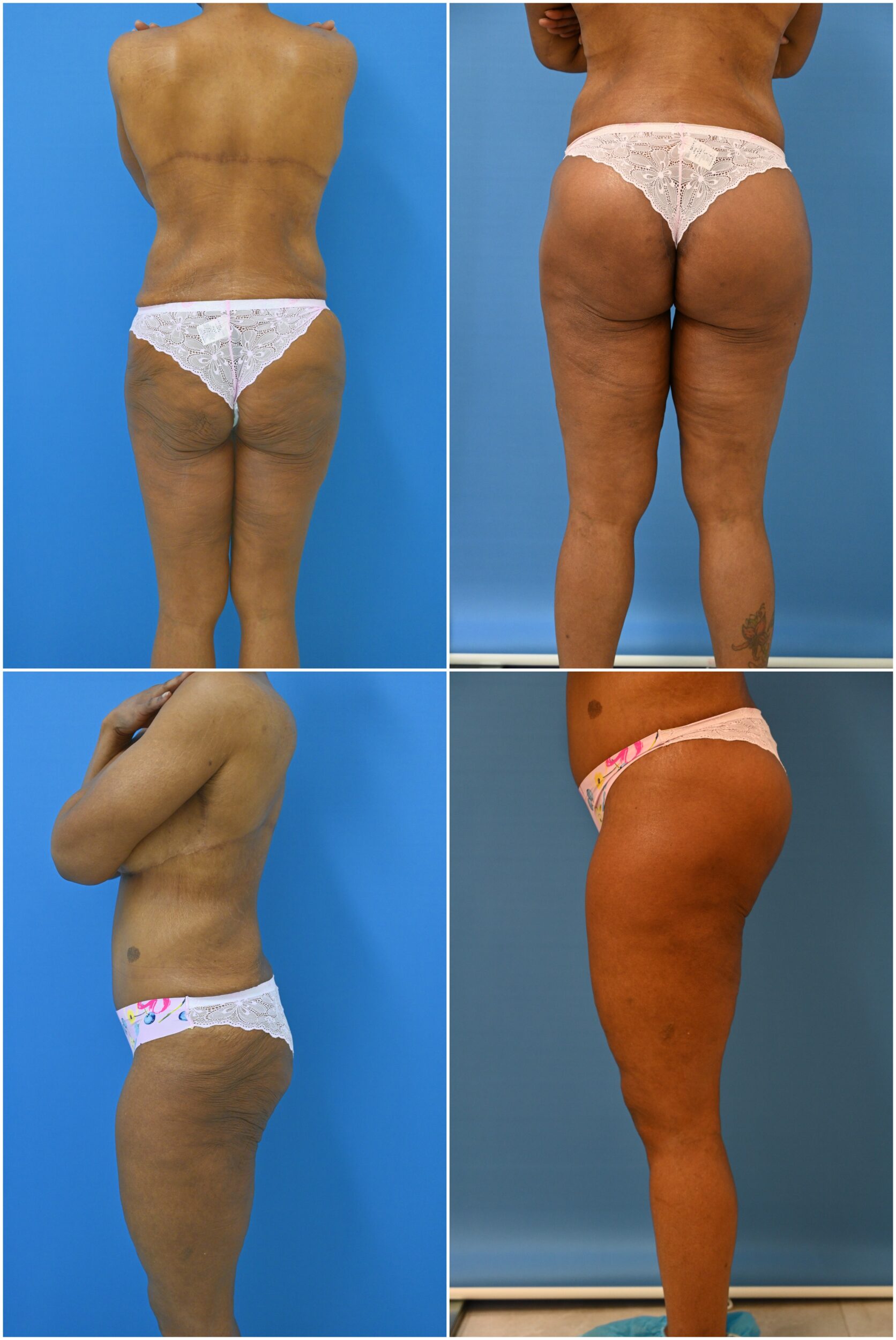 Before and After Image: Thigh Lift - other