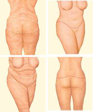 body Body Lift in Miami, FL