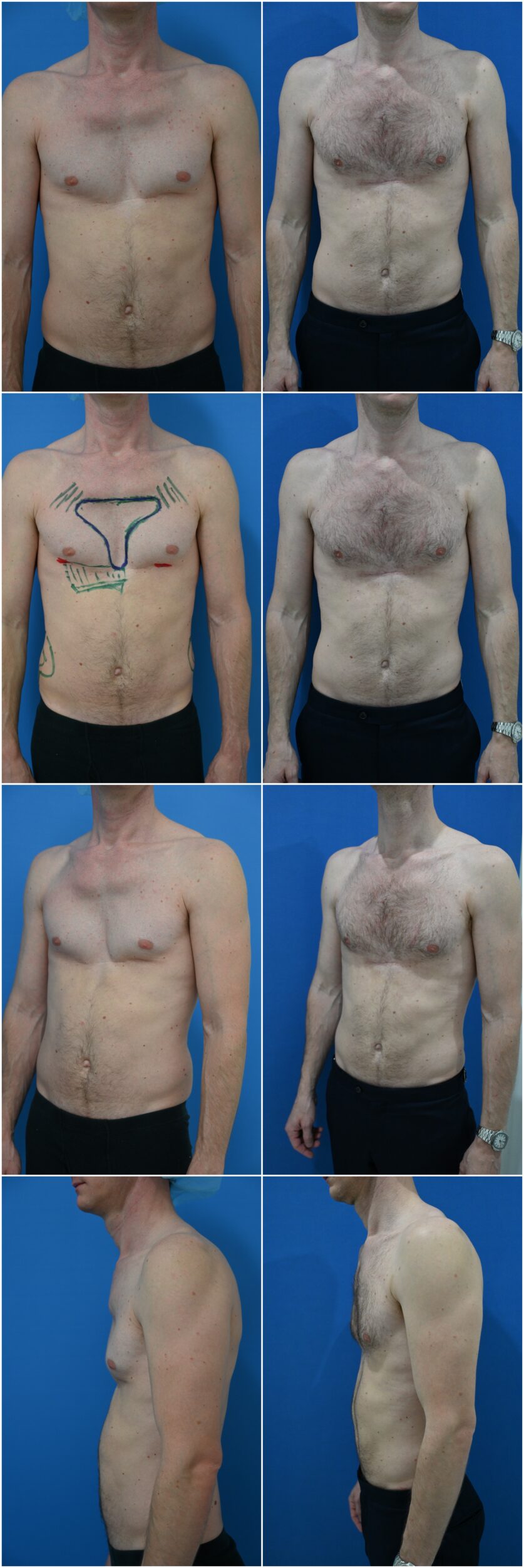 Before and After Image: Male Pectoral Implants - other