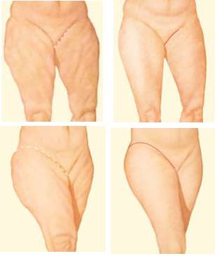 thighs Thigh Lift in Miami, FL