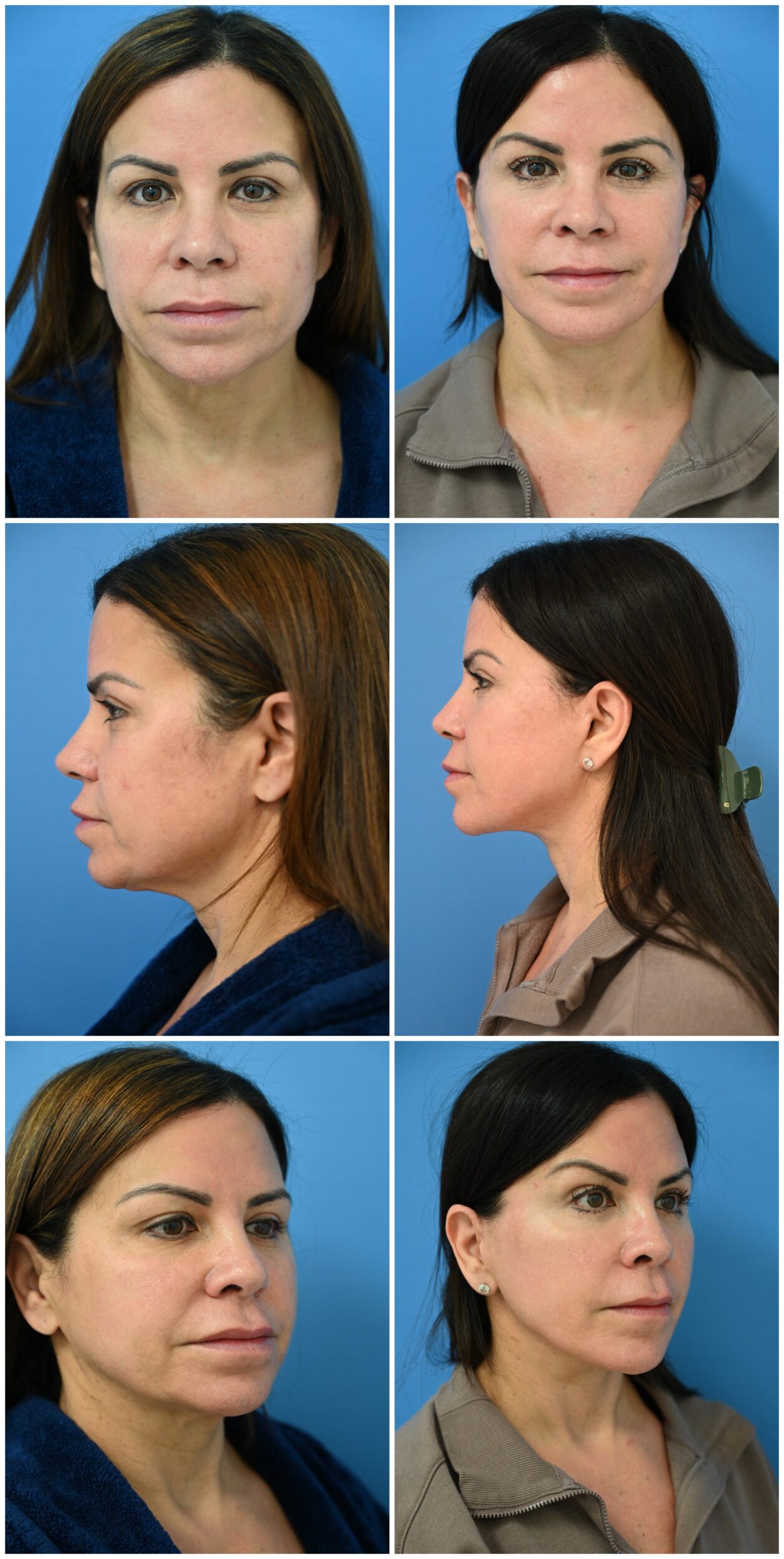 Before and After Image: Face and Necklift - other