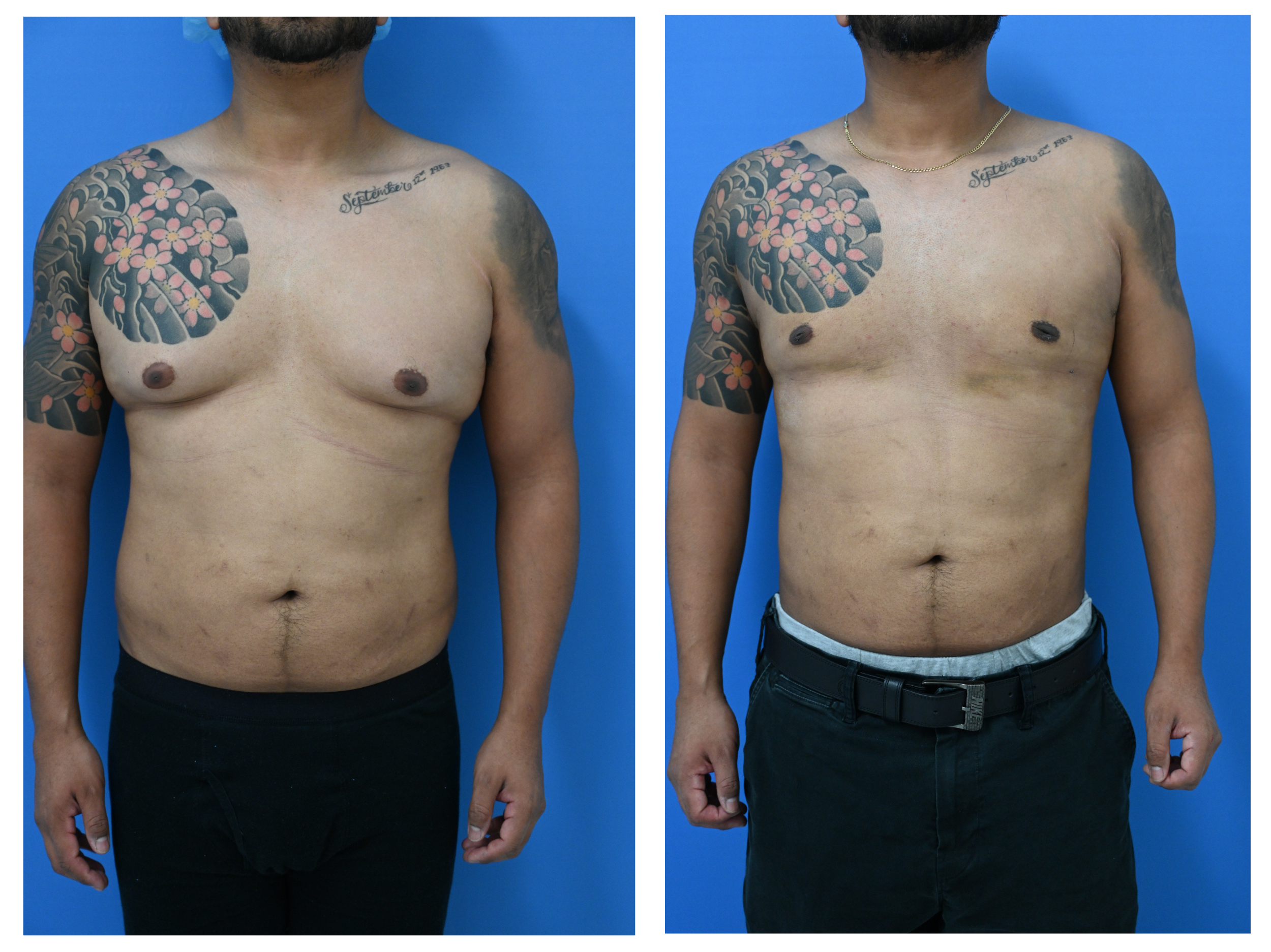 Before and After Image: Gynecomastia Repair with Liposuction Body Contouring – Age 34 - front