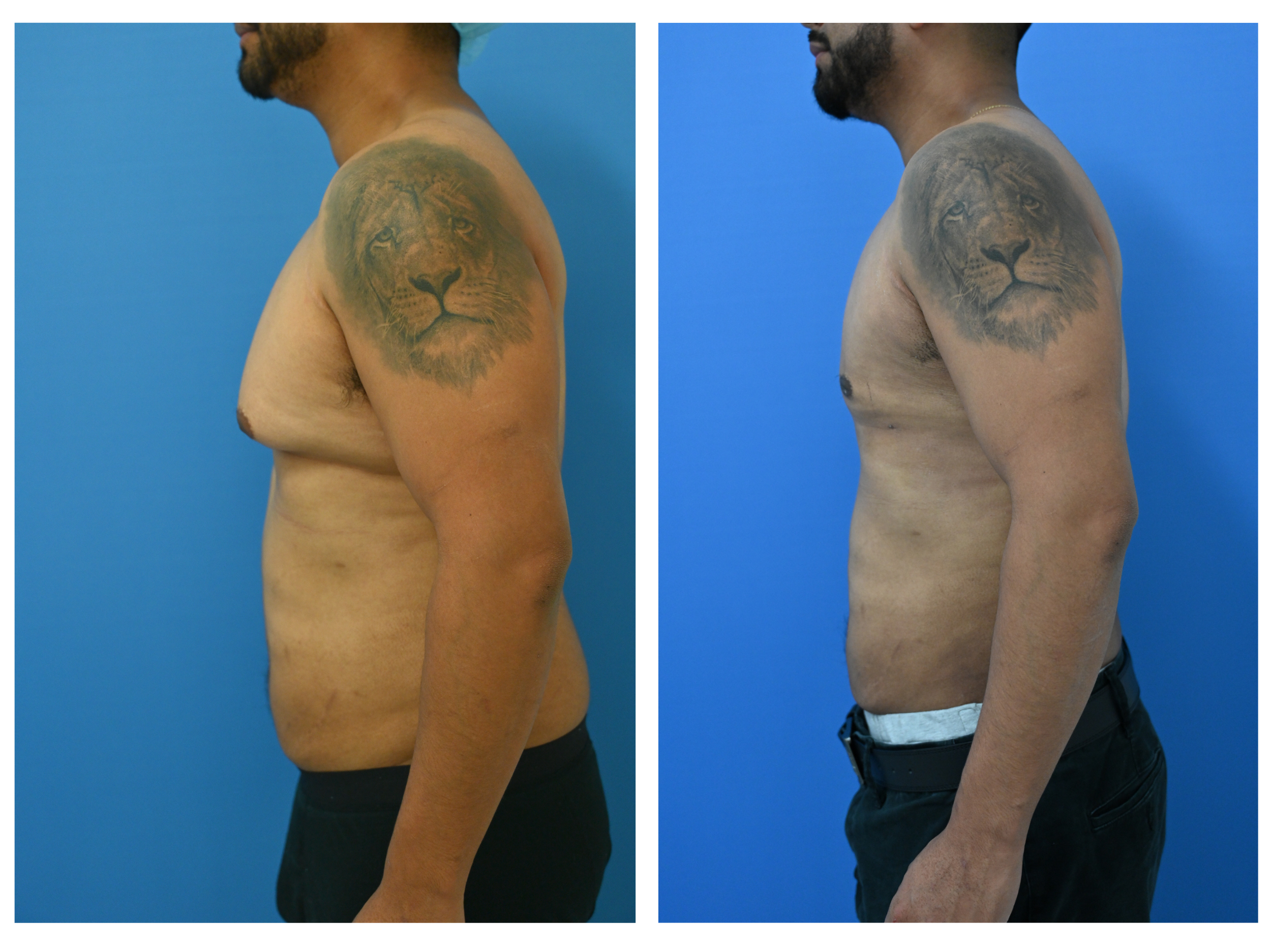 Before and After Image: Gynecomastia Repair with Liposuction Body Contouring – Age 34 - left-side