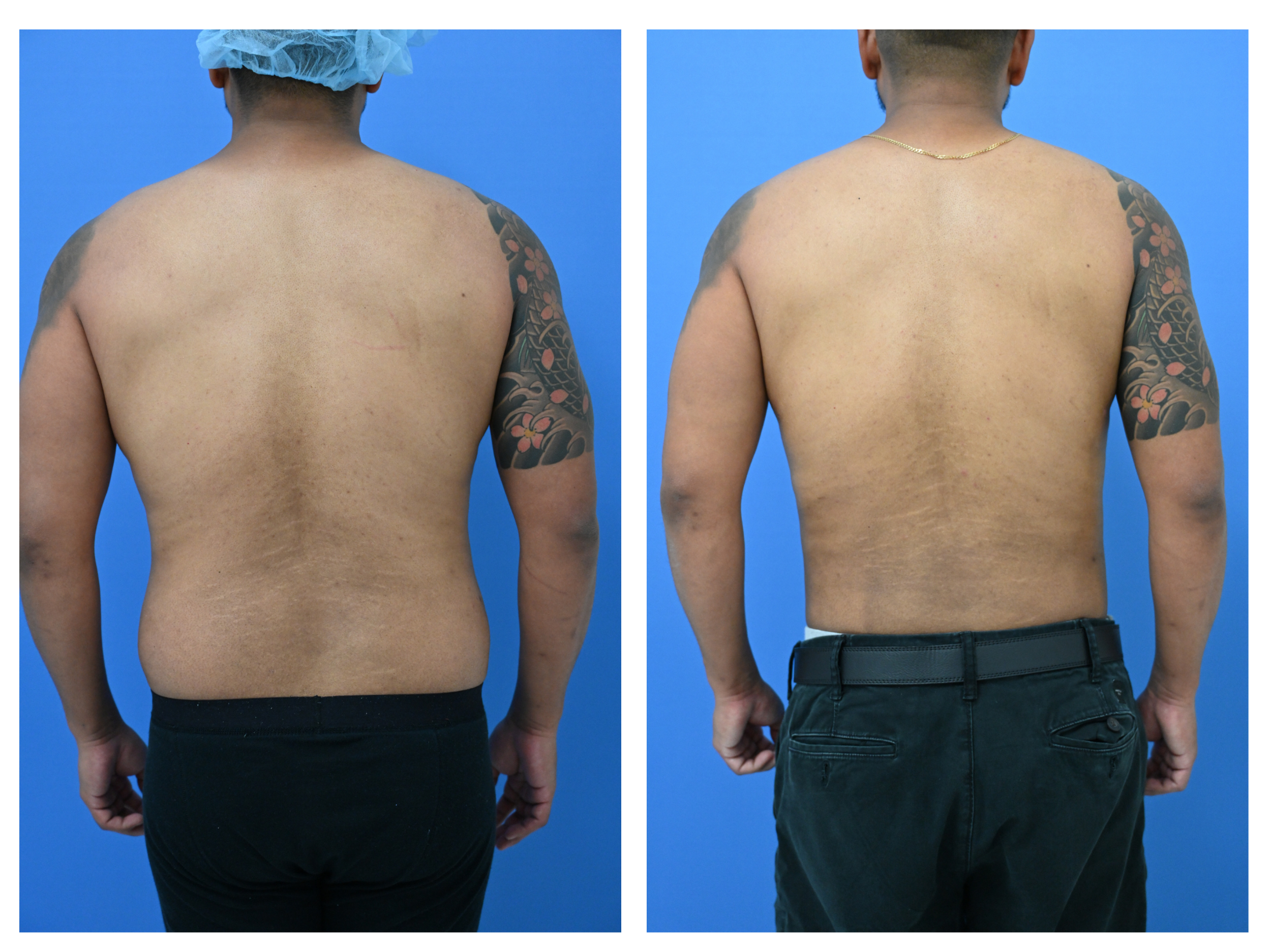 Before and After Image: Gynecomastia Repair with Liposuction Body Contouring – Age 34 - back