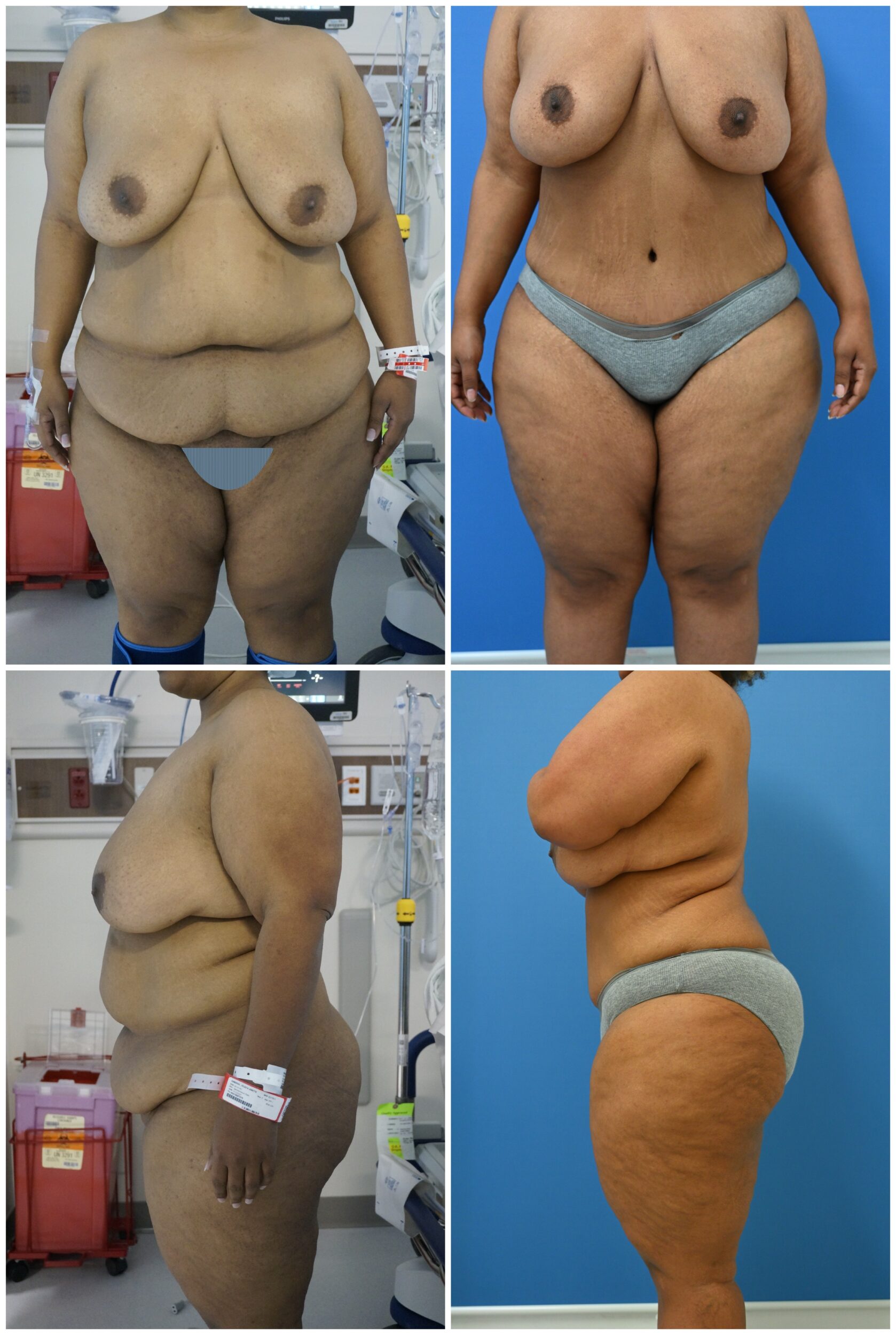 Before and After Image: Tummy Tuck (Abdominoplasty) - front
