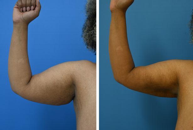 Before and After Image: Liposuction - front