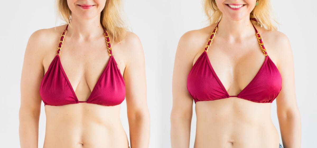Before and after of a woman's chest who has had a breast augmentation for fuller, natural-looking breasts.