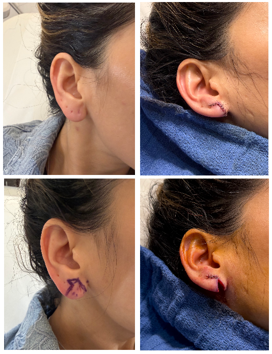 Before and After Image: Ear Lobe Reduction - front