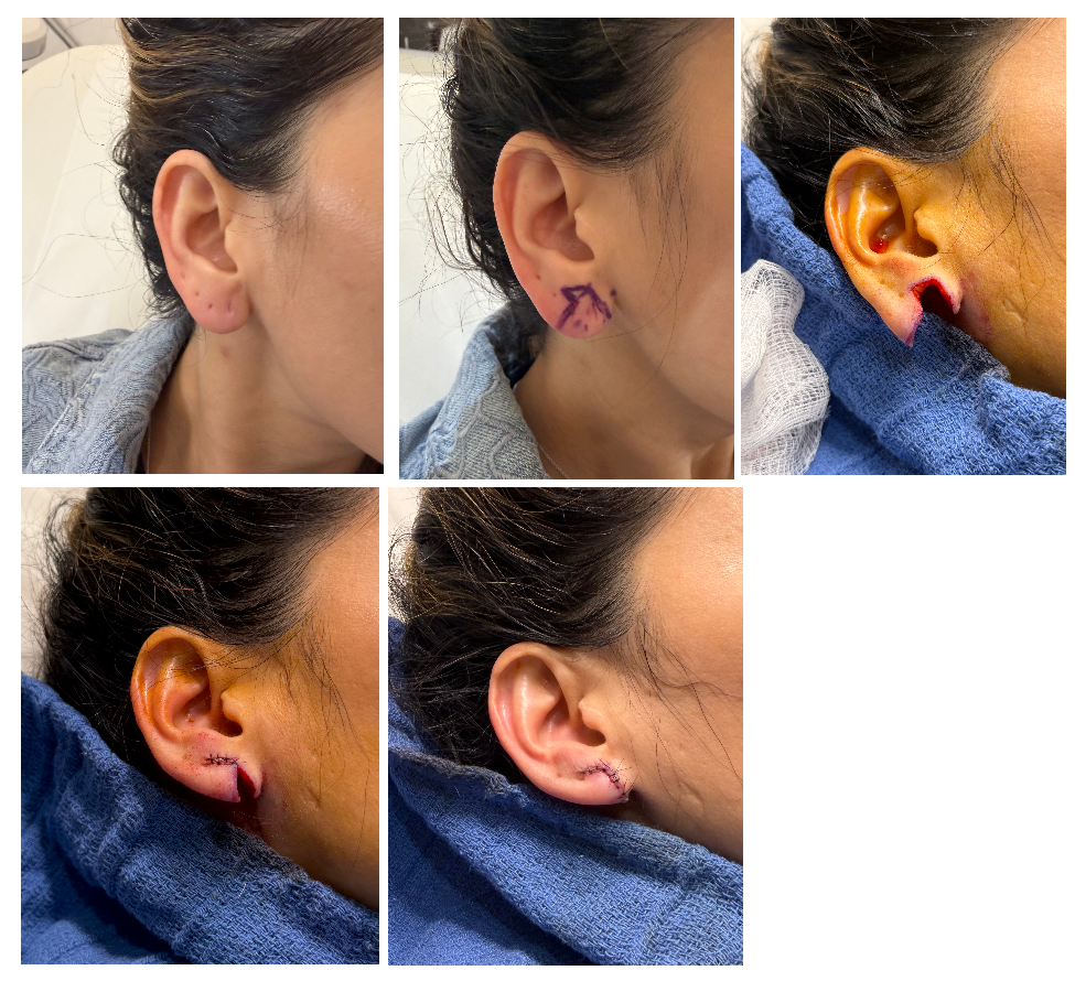 Before and After Image: Ear Lobe Reduction - front