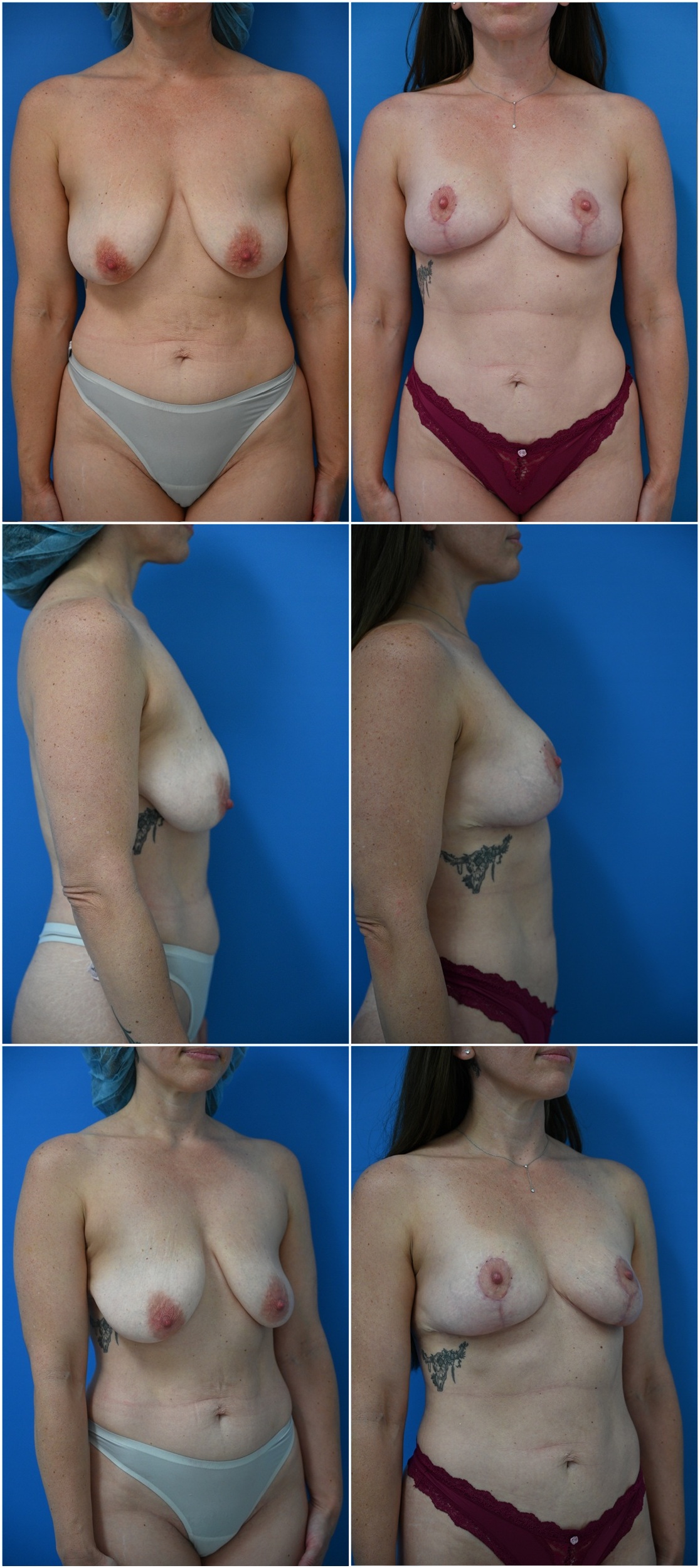 Before and After Image: Breast Lift - other