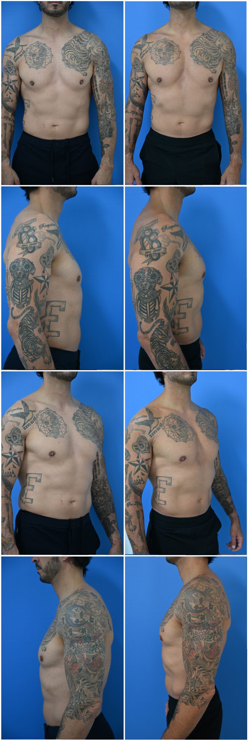 Before and After Image: Male Pectoral Implants - other