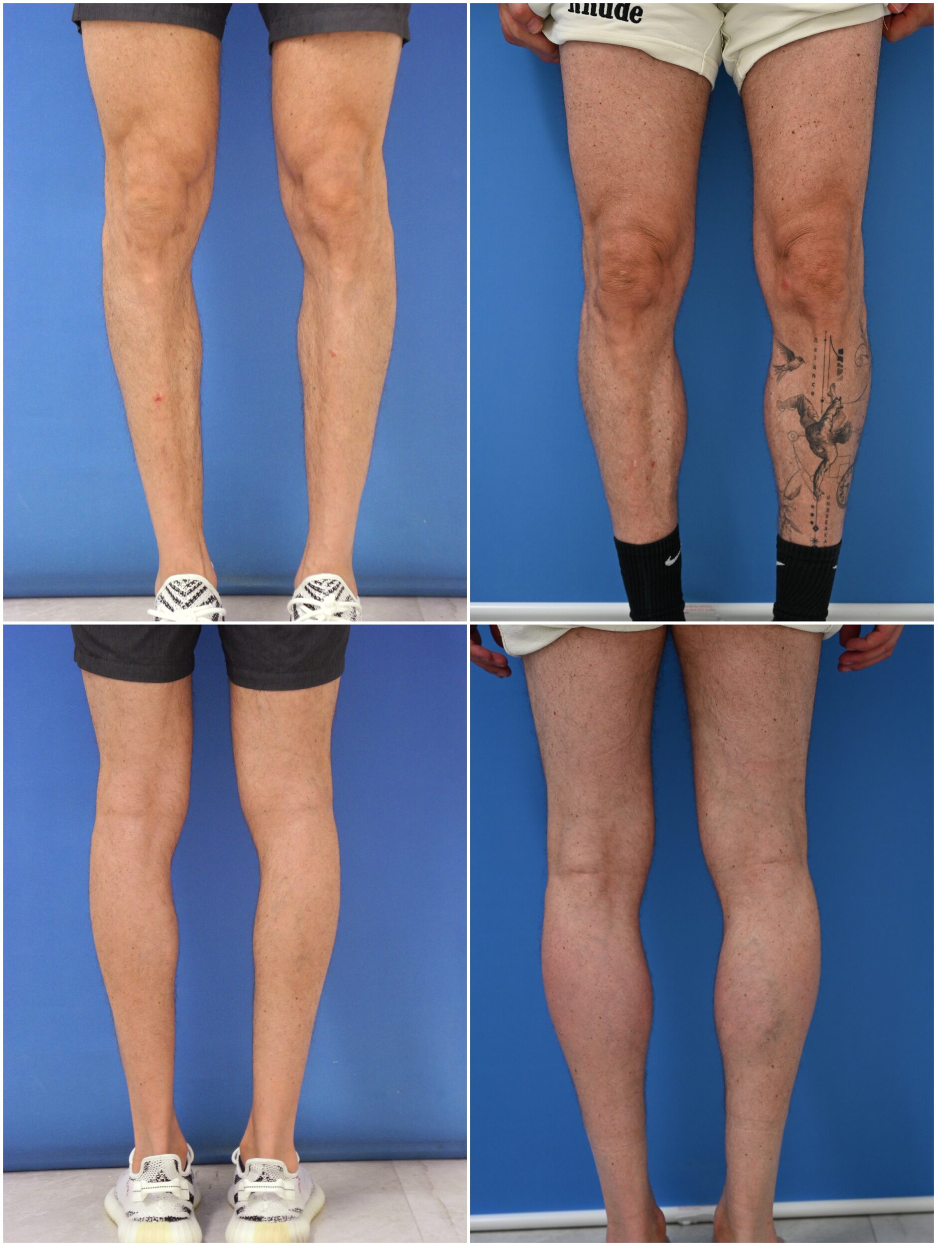 Before and After Image: Calf Augmentation - other