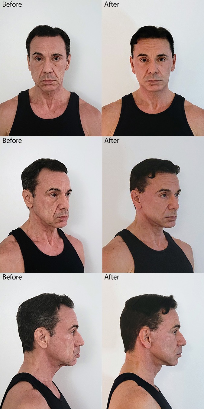 Before and After Image: Face and Necklift - other