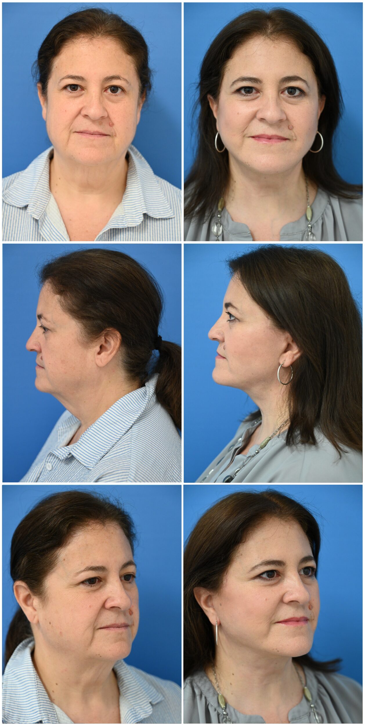 Before and After Image: Facelift - other