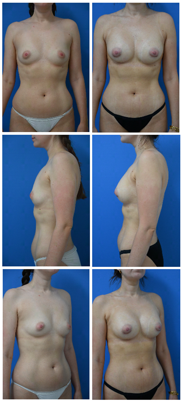 Before and After Image: Breast Augmentation - front