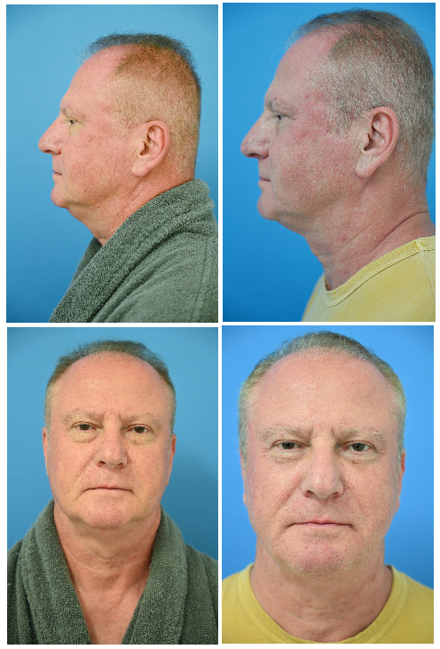 Before and After Image: Neck Liposuction Surgery - front
