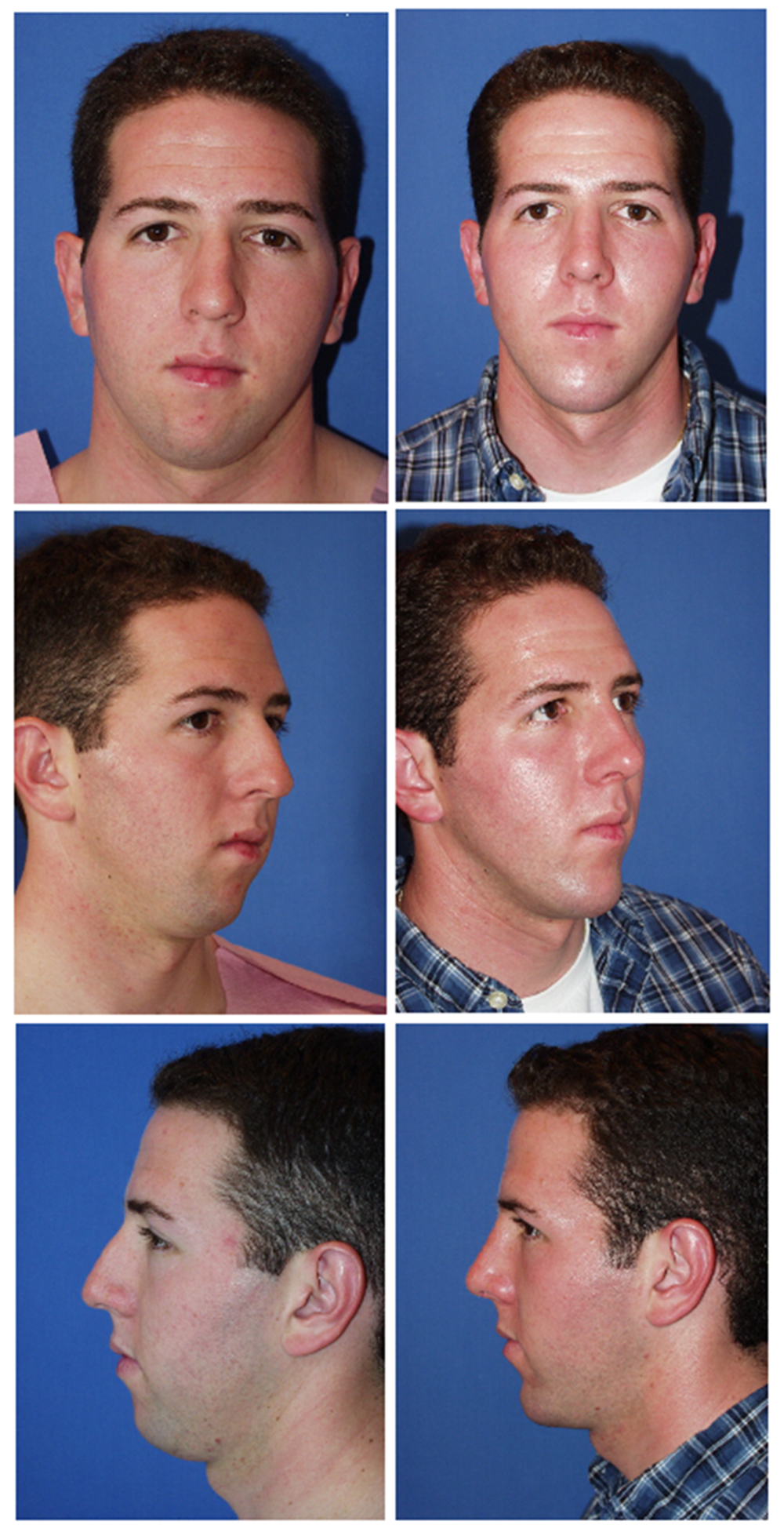 Before and After Image: Rhinoplasty - front