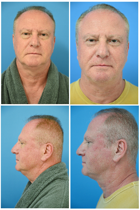 Before and After Image: Eyelid Lift Surgery (Blepharoplasty) - front